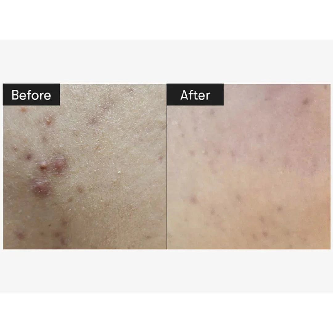 VT Reedle Shot 100 Cica Reedle